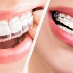 Eliners ou aparelhos: qual método é mais correto para correção de dentes